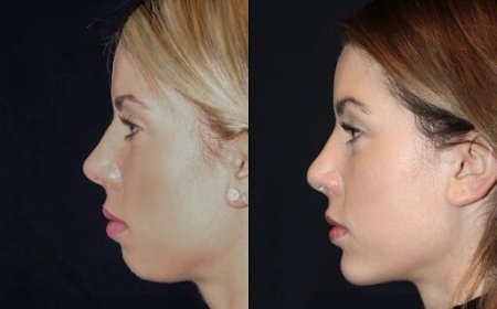 Best Aesthetic Clinic in dubai for Chin Fillers: What You Should Ask Your Doctor