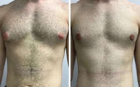 Advanced Techniques Used by the Best Doctors in Dubai for Gynecomastia