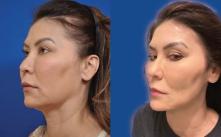 Is Thread Lift Right for You Consultation Insights from the Best Aesthetic Clinic in Dubai