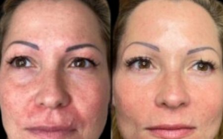 Tune Your Glow with Profhilo in Dubai