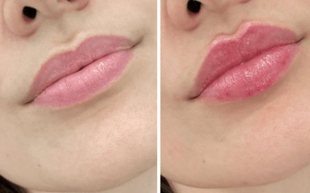 How Juvederm Enhances Your Appearance Without Surgery: Expert Advice from the Best Plastic Surgeon in Dubai