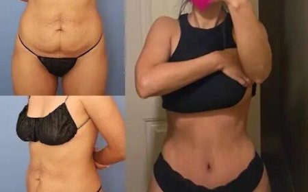 Tummy Tuck in Dubai: Why You Should Choose the Best Surgeons