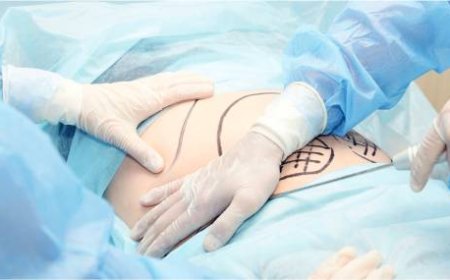 Tummy Tuck in Dubai: Achieve a Flatter Abdomen with Precision Surgery