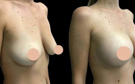 Breast Augmentation Trends Explained by the Best Doctors in Dubai