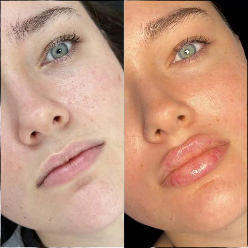 Best Aesthetic Clinic in dubai for Fillers: How to Maintain Your Appearance