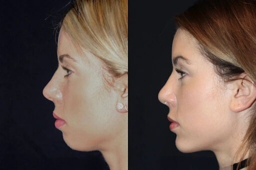 Best Aesthetic Clinic in dubai for Chin Fillers: What You Should Ask Your Doctor