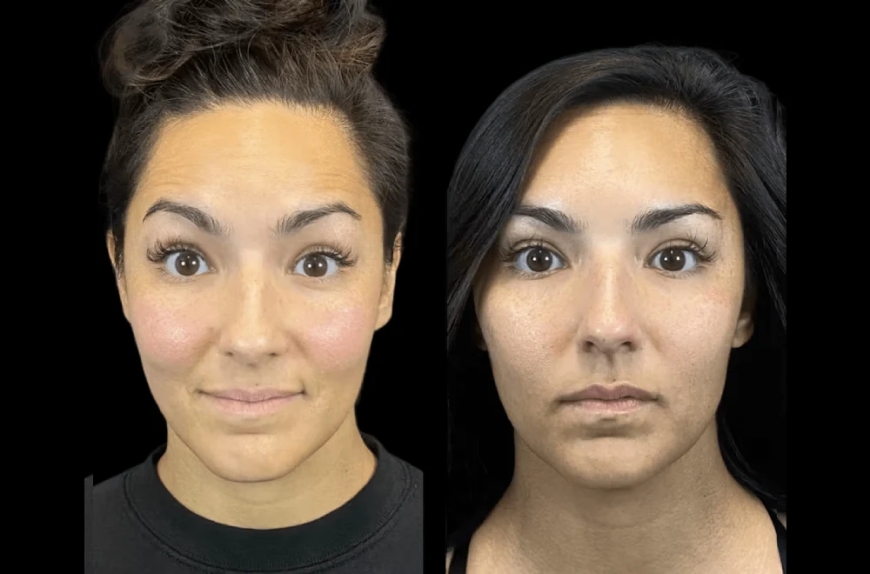 Why More Women Are Choosing the Best Aesthetic Clinic in dubai for Preventative Botox