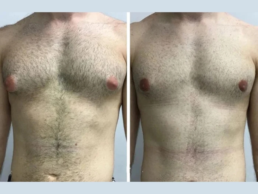 Advanced Techniques Used by the Best Doctors in Dubai for Gynecomastia