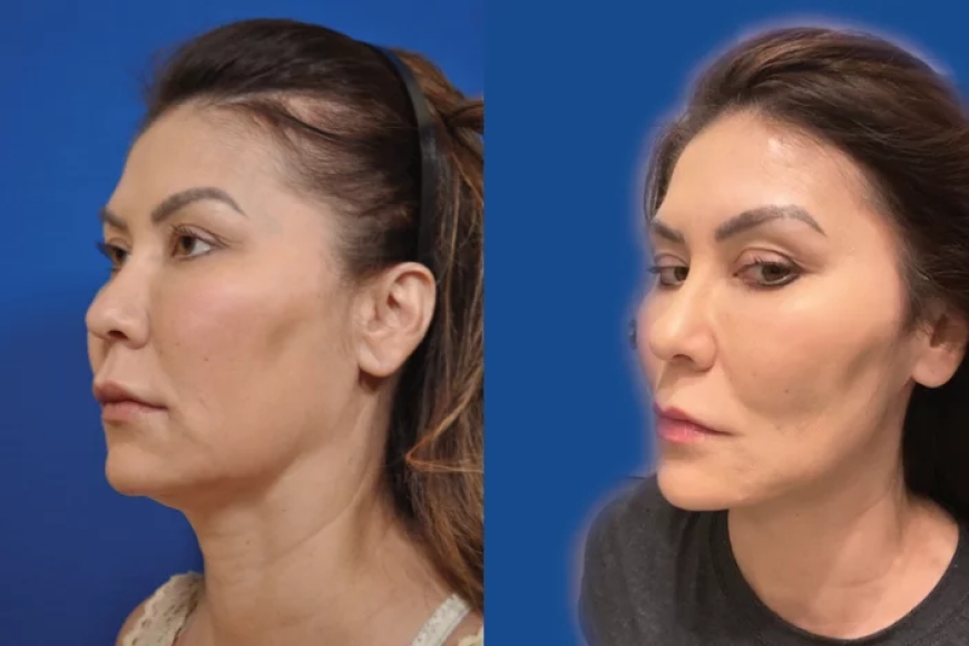 Is Thread Lift Right for You Consultation Insights from the Best Aesthetic Clinic in Dubai