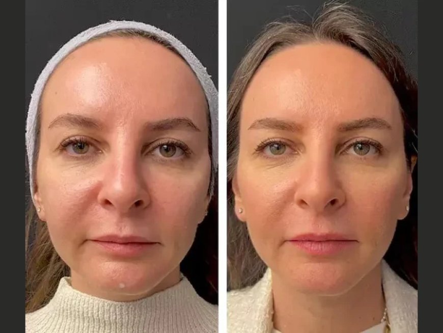 Mesotherapy for Glowing Skin: Top Treatments at the Best Aesthetic Clinics in Dubai