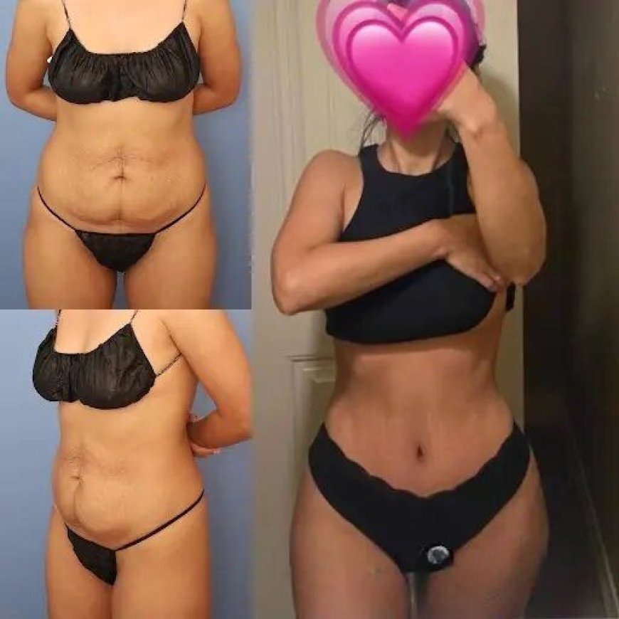 Tummy Tuck in Dubai: Why You Should Choose the Best Surgeons