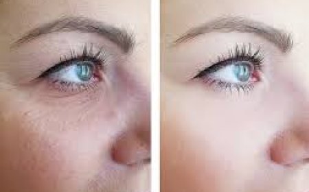 How much does under-eye laser wrinkle treatment cost?