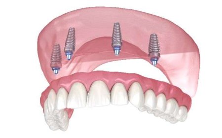 Achieve Lasting Smile Health with Local Care in London